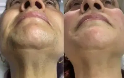 Epilare definitivă laser în Bacău